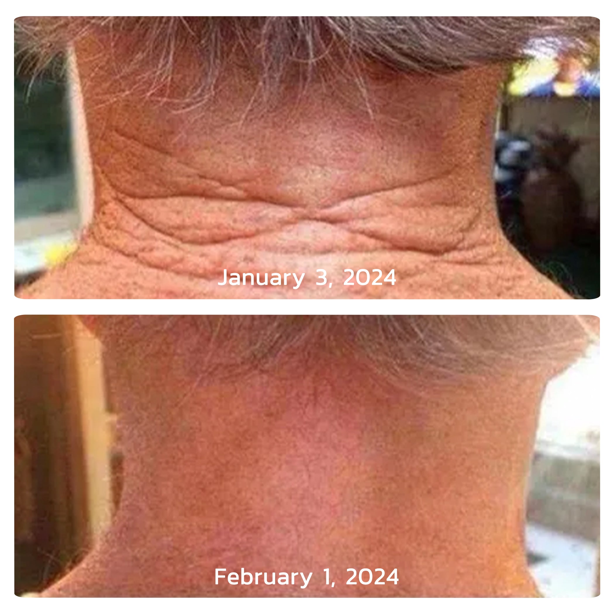 before after neck